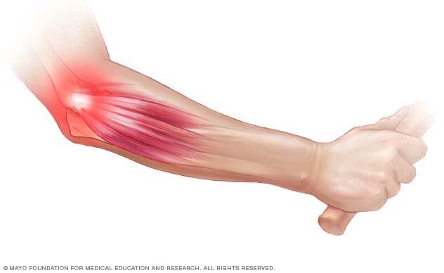 Understanding Tennis Elbow: Causes, Symptoms, and Traditional Treatments